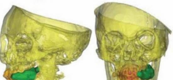 少女的头骨（黄色）、牙齿（橙色）、舌头（红色）和古柯叶（绿色）的3D可视化。少女嘴里还有残余了几片古柯叶。