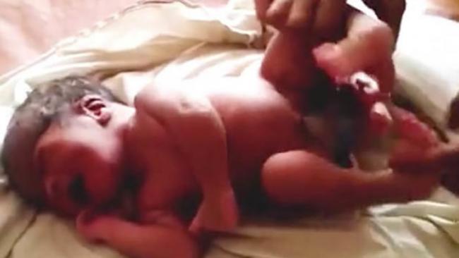 印度北方邦戈勒克布尔一名孕妇产下4条腿男婴
