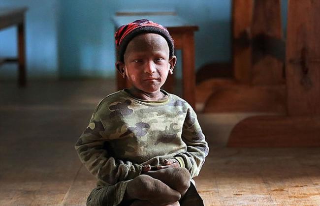 尼泊尔男童患鱼鳞癣 不能说话行走如石头人