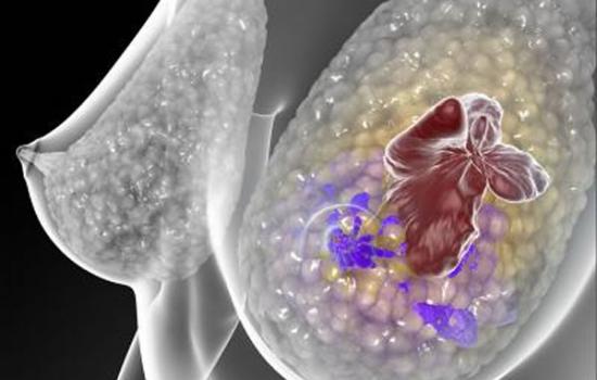 研究人员报告说，病人血液中的循环肿瘤DNA可在看似根治性疗法后被用来预测早期乳腺癌复发的可能性。