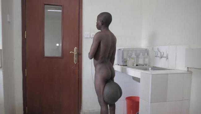 肯尼亚男子罹患怪病 睾丸是一般人的10倍大