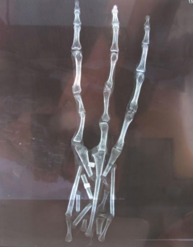 X光显示鬼爪比人类的手指多一节指骨。