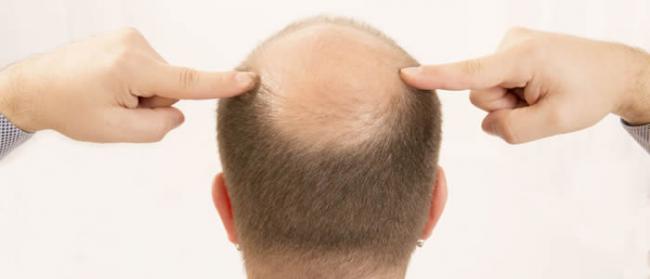 欧洲专家：不到40岁就秃头或头发变白的男性患心血管疾病的风险偏高