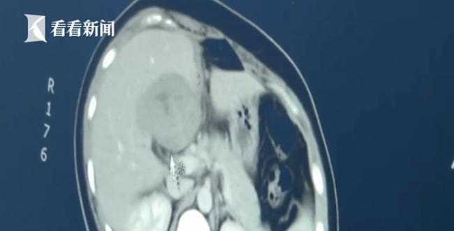 安徽省天长市女子上腹肿痛 断层扫描一照居然是肝脏受精怀孕了