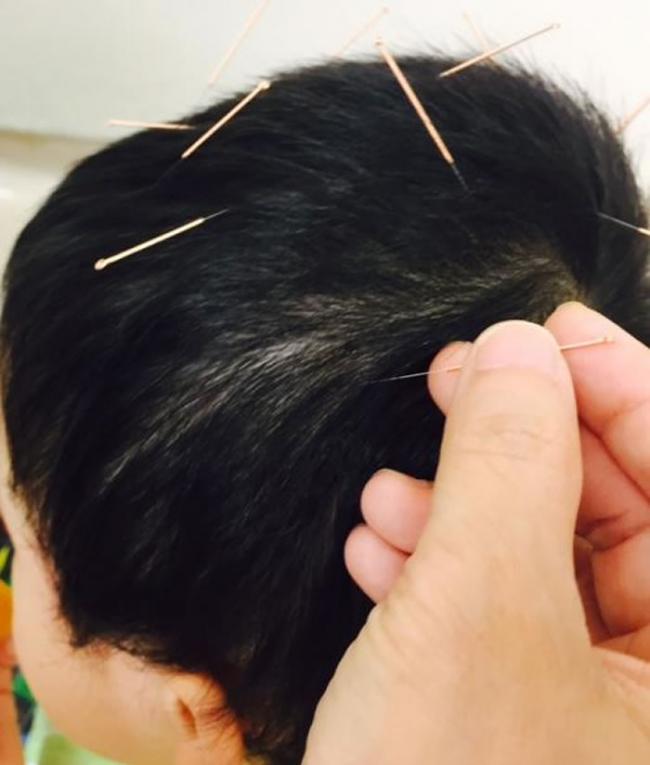 香港浸会大学中医药学院临床观察显示头皮针能有效治疗儿童自闭症