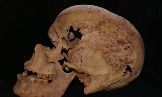 考古学家在该具有4千年历史的女性骸骨中，发现乳癌病变迹象。