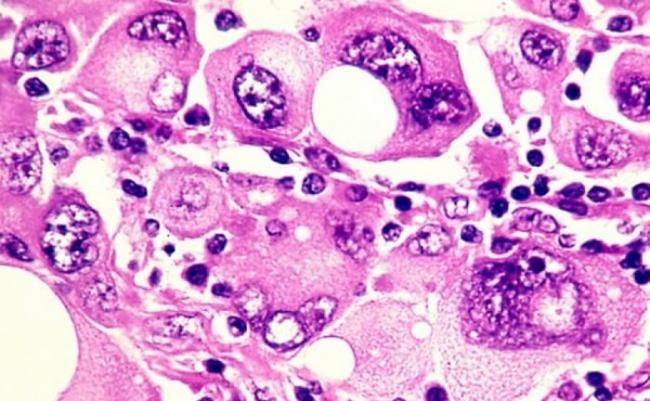 皮肤癌治疗突破 澳洲科学家研黑色素瘤血液测试