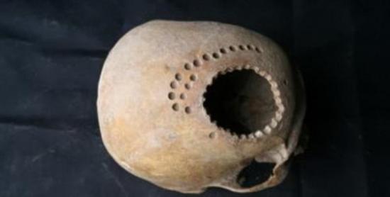 最新考古研究发现，1000年前秘鲁医生能够操作头颅手术，图中是在患者头骨上钻了数十个小洞