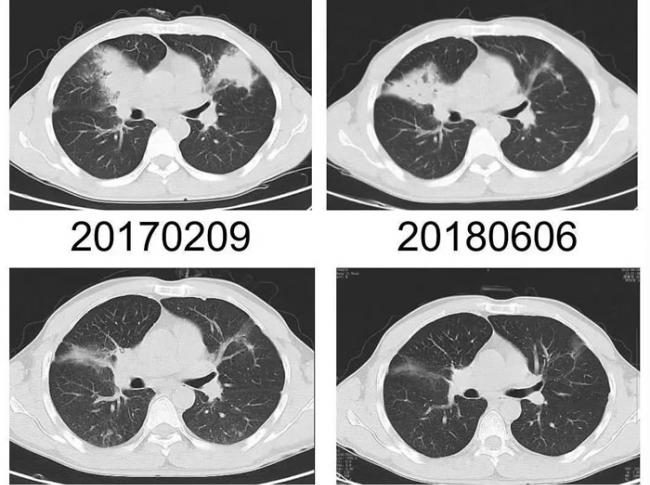 李先生的肺部CT图