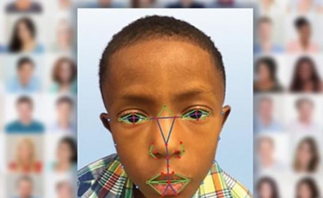 脸部侦测技术软件可辨别出罕有遗传病。