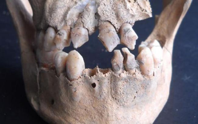 头骨的牙齿有锉过的痕迹，表明此人可能是非洲起源，发现于圣马丁加勒比岛。