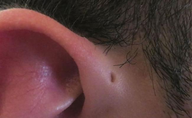 部分亚洲人耳边位置有个洞 “耳前窦”可能是进化残留物