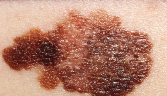 澳洲当局指，晒太阳灯与恶性黑色素瘤(图)增生有直接关系。