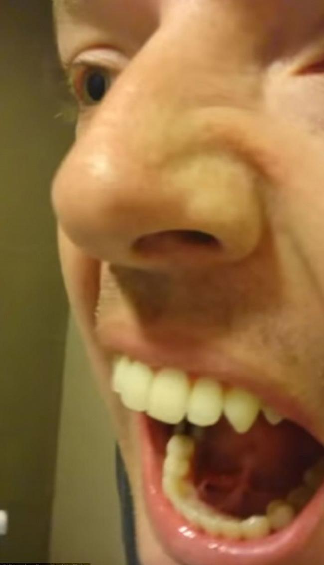 恶心：美国男子拍片分享自行挤出唾液腺结石 犹如一条怪虫