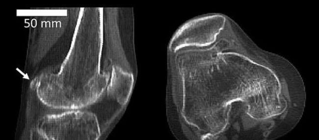 豆骨(fabella)，是位于膝盖后方肌腱中的一块小骨骼，目前它在人体存在的概率是100年前的3倍，全球五分之二居民都长有豆骨。