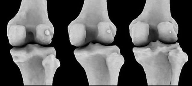 图中显示3个不同膝骨样本存在不同大小的豆骨。科学家发现1918年全球11.2%居民体内存在豆骨，但截至2018年，全球39%居民体内存在豆骨。