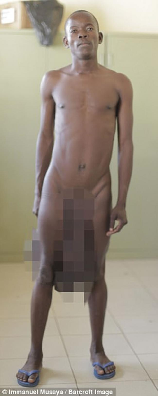 肯尼亚21岁男子Forence Owiti Opiyo缩阳成功 曾经91公分阴茎5公斤睾丸