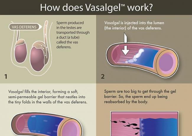 美国医疗研究机构“帕萨默斯基金会”成功研究男性避孕针Vasalgel