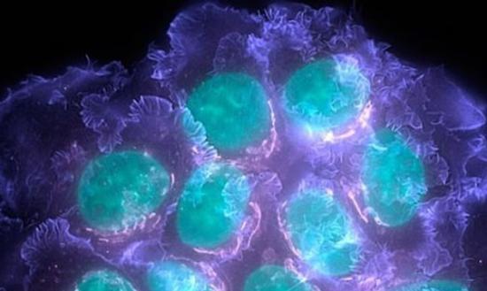 乳癌细胞会改变骨头结构