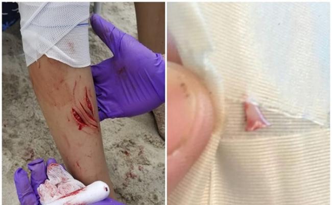 救护员为女童治理腿部被鲨鱼咬的伤口（左图），并在男童腿部拔出一只鲨鱼牙。