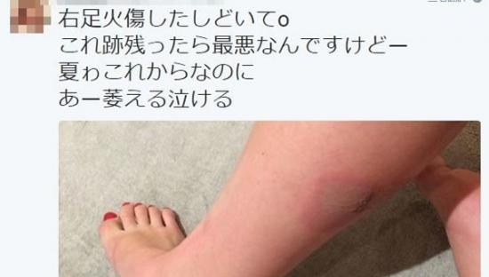 日本女网友PO灵异照“鬼手抓脚” 4天后小腿出现诡异烧伤