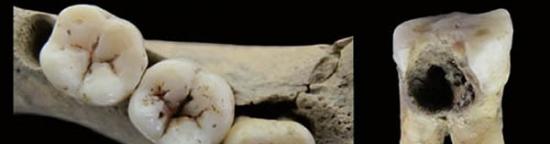 青龙泉新石器时代居民龋齿病变，A下颌臼齿咬合面龋齿，B上颌臼齿近中面龋齿。（周蜜供图）