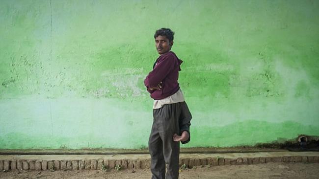 印度北方邦男子Arun Kumar天生就有四条腿