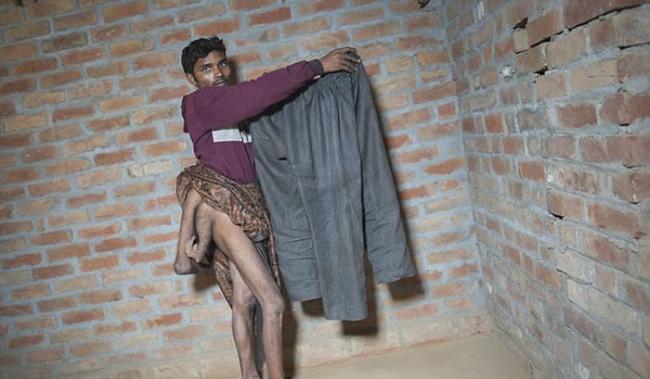 印度北方邦男子Arun Kumar天生就有四条腿
