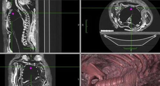 研究人员对加拿大皇家安大略博物馆一具木乃伊尸体空腹体腔进行了CT切片和3D结构重建