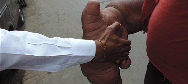 印度男子患“局部巨人症”右臂重20公斤 被称魔鬼的孩子