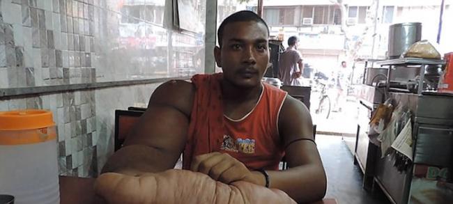 印度男子患“局部巨人症”右臂重20公斤 被称魔鬼的孩子