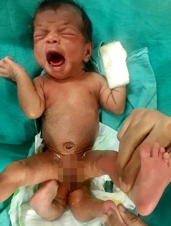 印度吉吉拉特邦5个月大女婴出生时就有4只脚 被视为受诅咒的怪物