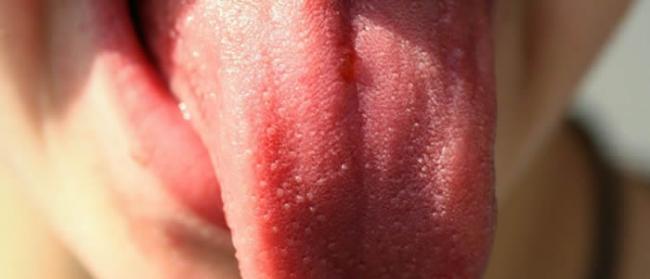 舌头光滑、胖大、发红可能是缺乏维生素B12的表现 会增加恶性贫血风险