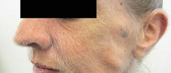 澳大利亚维克多利亚州墨尔本市一名女性吸烟者因肺癌脸上长满了毛发