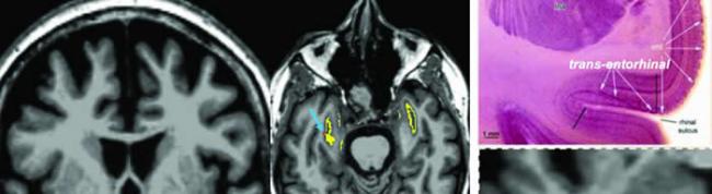 自动成像揭示阿尔茨海默氏病的脑中TAU蛋白起源